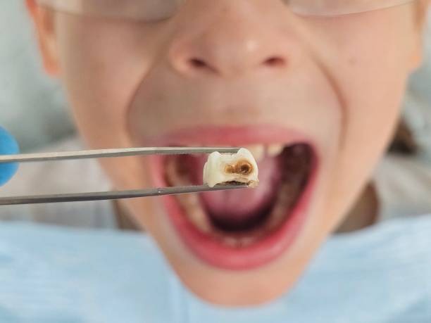 Best Emergency Dentist for Knocked-Out Tooth in Newberry, SC